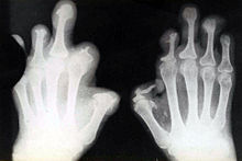 røntgenbilde av deformerte hender